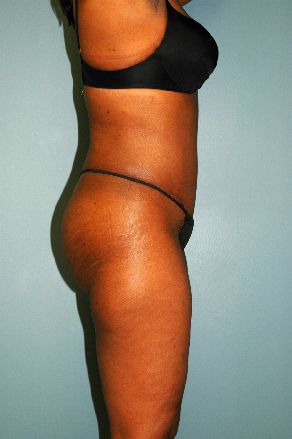 Before and After Tommy 5