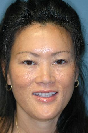 Before and After Botox 1