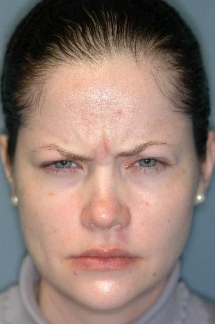 Before and After Botox 5