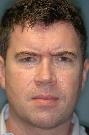 Before and After Botox 2