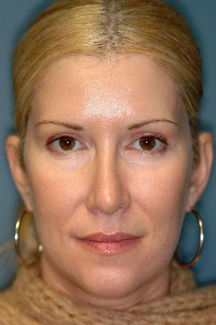 Before and After Botox 4