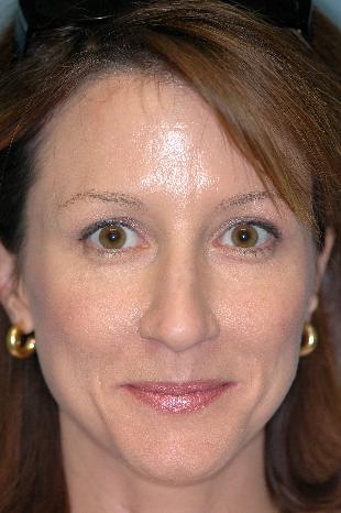 Before and After Botox 6