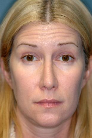 Before and After Botox 3