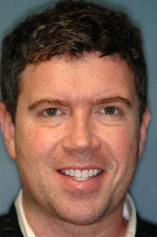 Before and After Botox 2