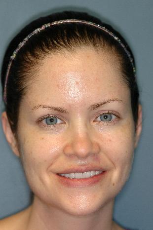 Before and After Botox 5