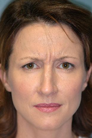 Before and After Botox 6