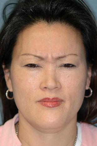 Before and After Botox 1