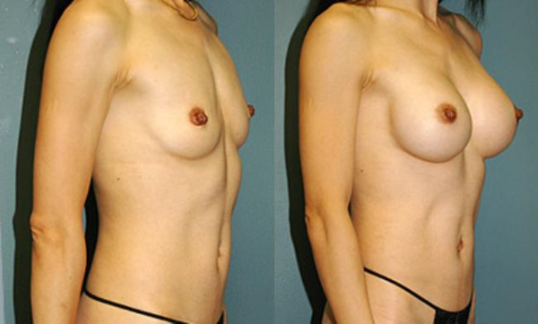 Before and After Breast Augmentation