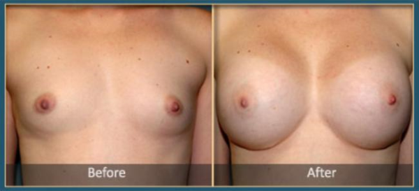 Before and After Breast Augmentation