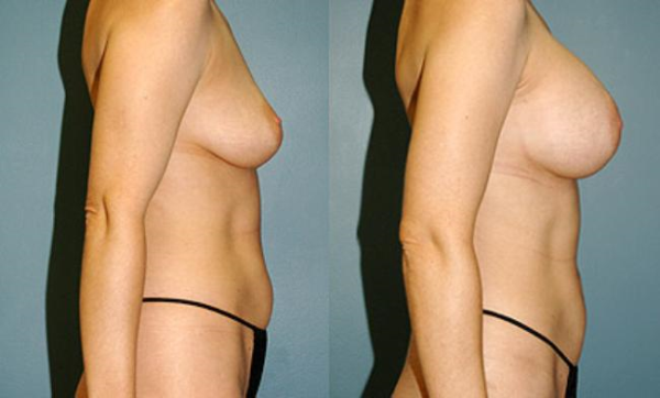 Before and After Breast Augmentation 3