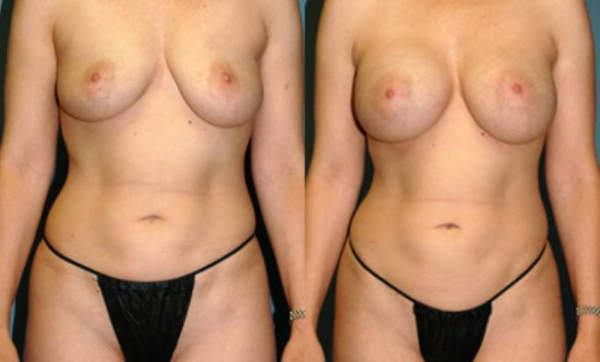 Before and After Breast Augmentation 3