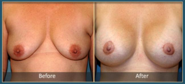 Before and After Breast Lift