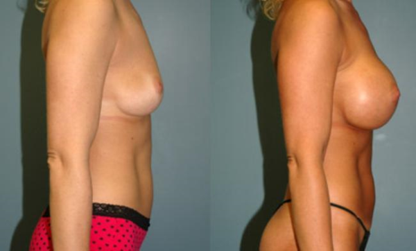 Before and After Breast Augmentation