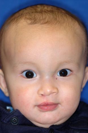 Before and After Cleft Lip 2