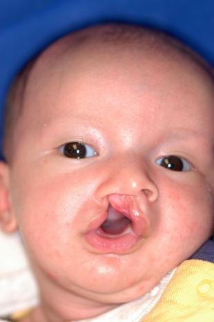 Before and After Cleft Lip 2