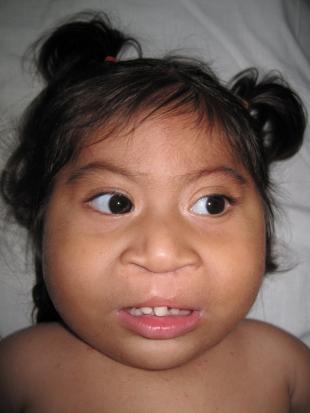 Before and After Cleft Lip