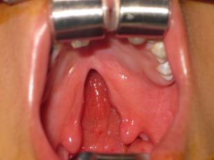 Before and After Cleft Palate