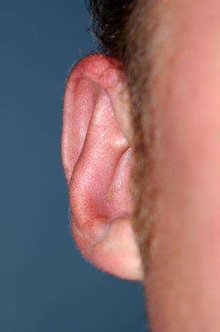 Before and After Pinning 2