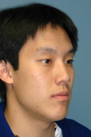 Before and After Jaw Surgery 2