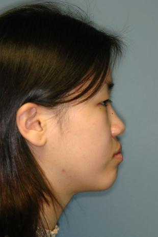 Before and After Jaw Surgery