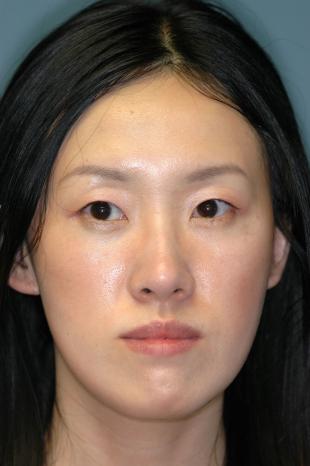 Before and After Jaw Surgery 3