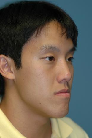 Before and After Jaw Surgery 2