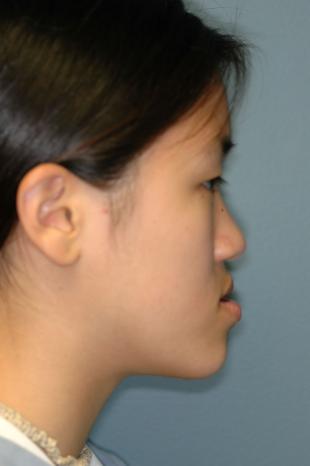 Before and After Jaw Surgery