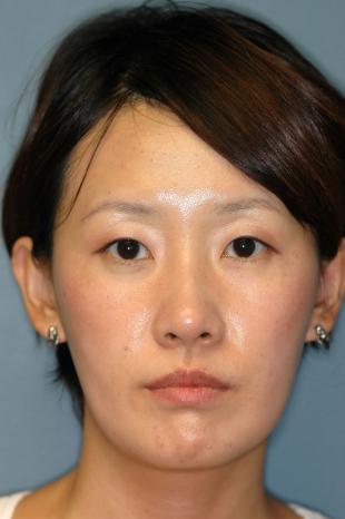 Before and After Jaw Surgery 3