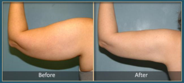 Before and After Liposuction 4