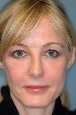 Before and After Radiesse 6