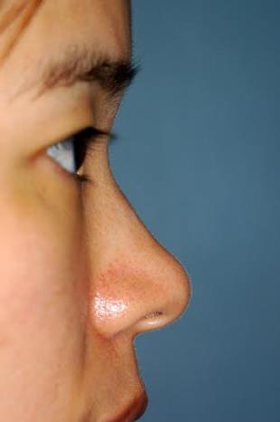 Before and After Radiesse 5