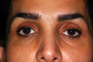 Before and After Radiesse 1