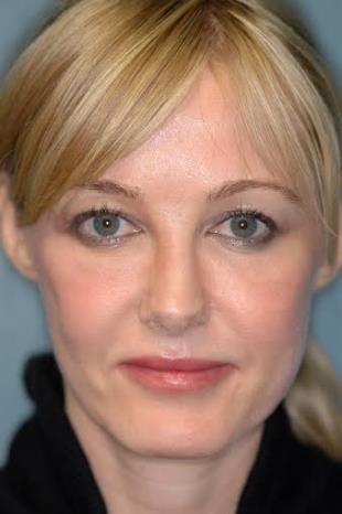 Before and After Radiesse 6