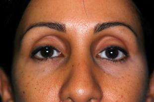 Before and After Radiesse 3