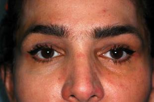 Before and After Radiesse 1