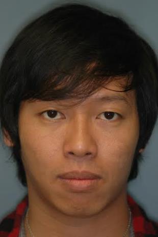 Before and After Radiesse 4