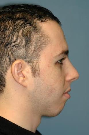 Before and After Radiesse 7