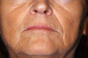 Before and After Radiesse 2