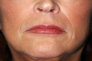 Before and After Radiesse 2