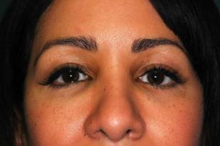 Before and After Radiesse 3