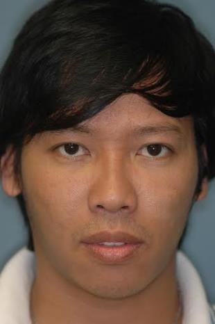 Before and After Radiesse 4