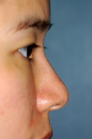 Before and After Radiesse 5