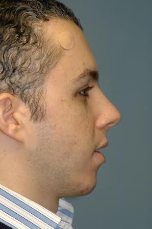 Before and After Radiesse 7