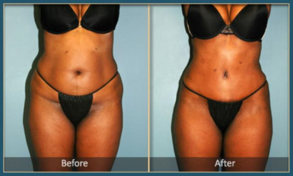 Before and After Tommy 4