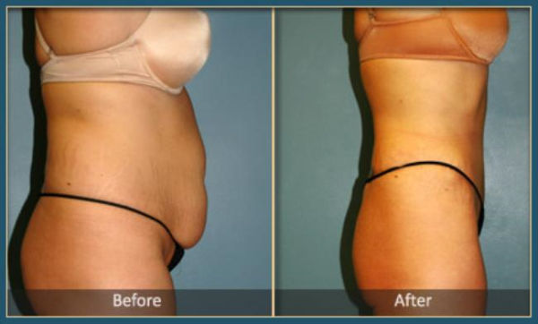 Before and After Tommy 5