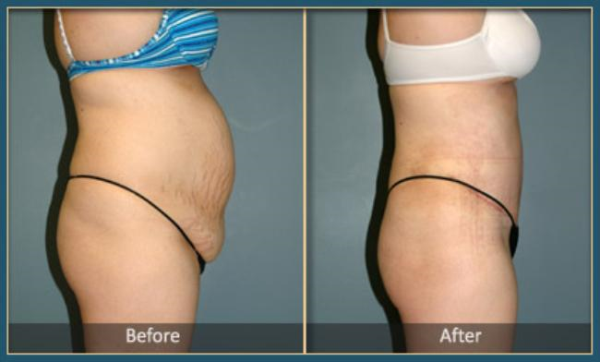 Before and After Tommy 3