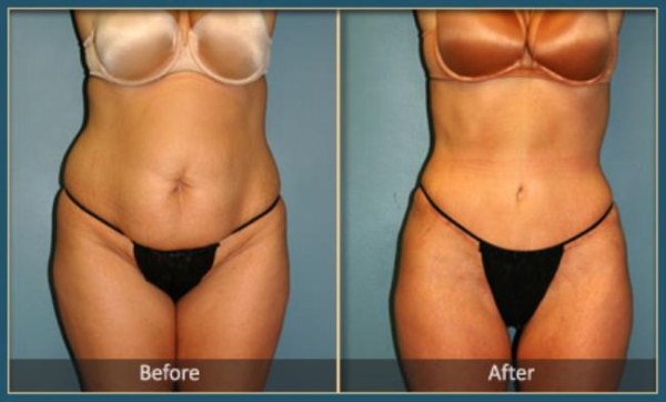 Before and After Tommy 4